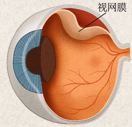 視網膜脫離