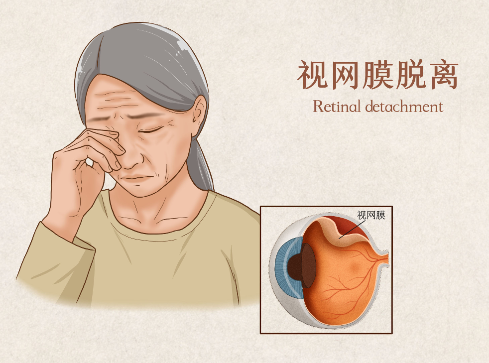 視網膜脫離