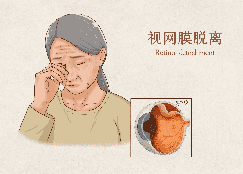 孔源性視網膜脫離